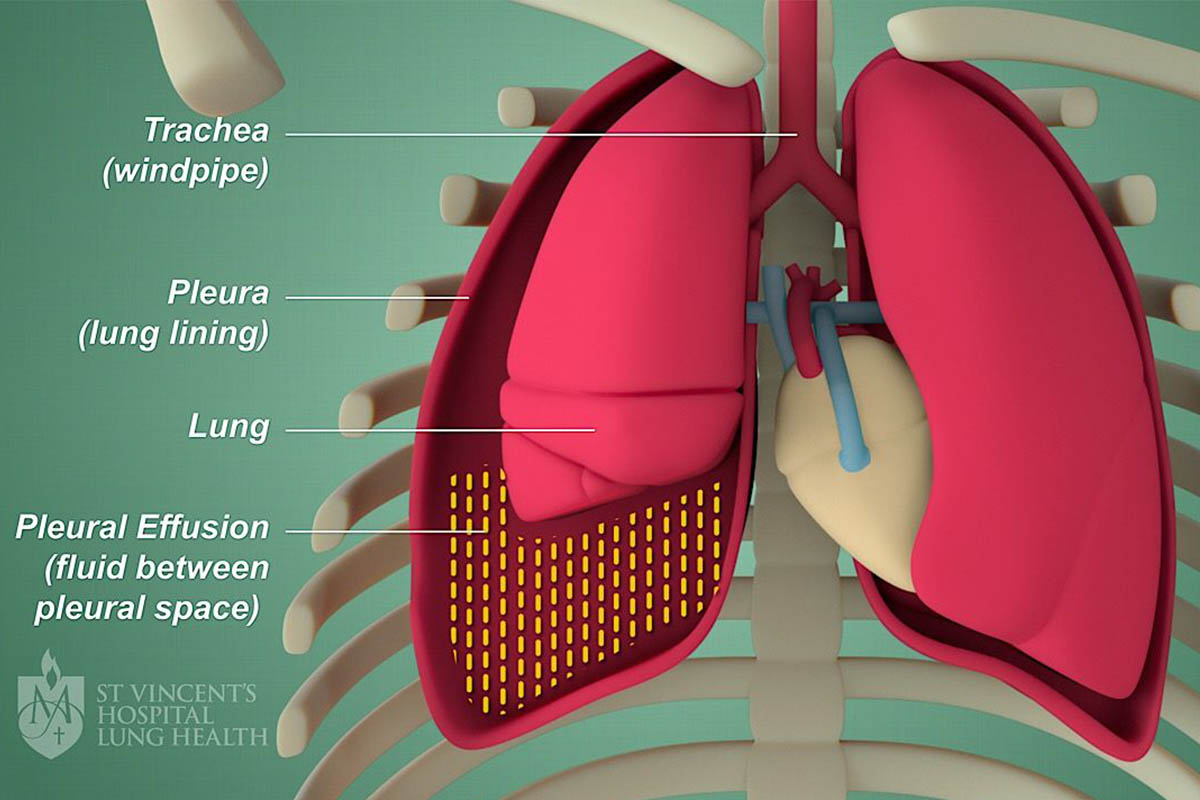 chest physician in Kandivali