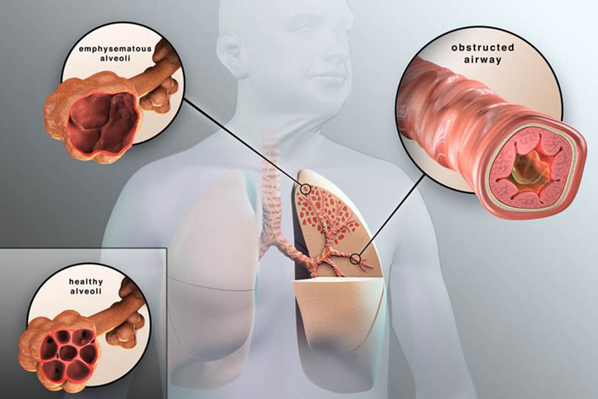 Pulmonologist in Kandivali