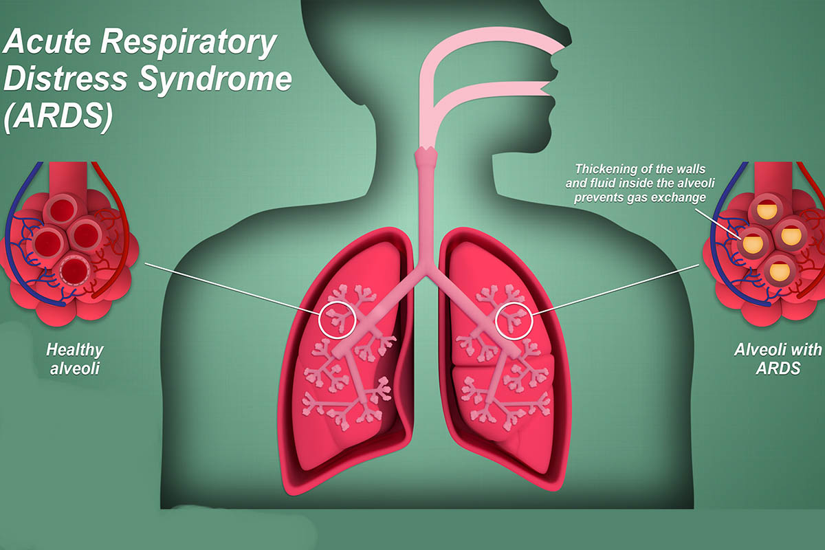 ARDS (Acute respiratory distress syndrome)